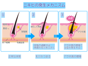 頭皮のニキビを撃退 アミノ酸シャンプーでニキビとおさらば